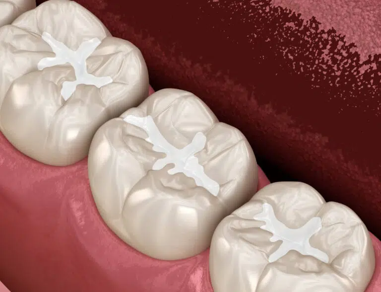 Protective Dental Sealants Newport Beach