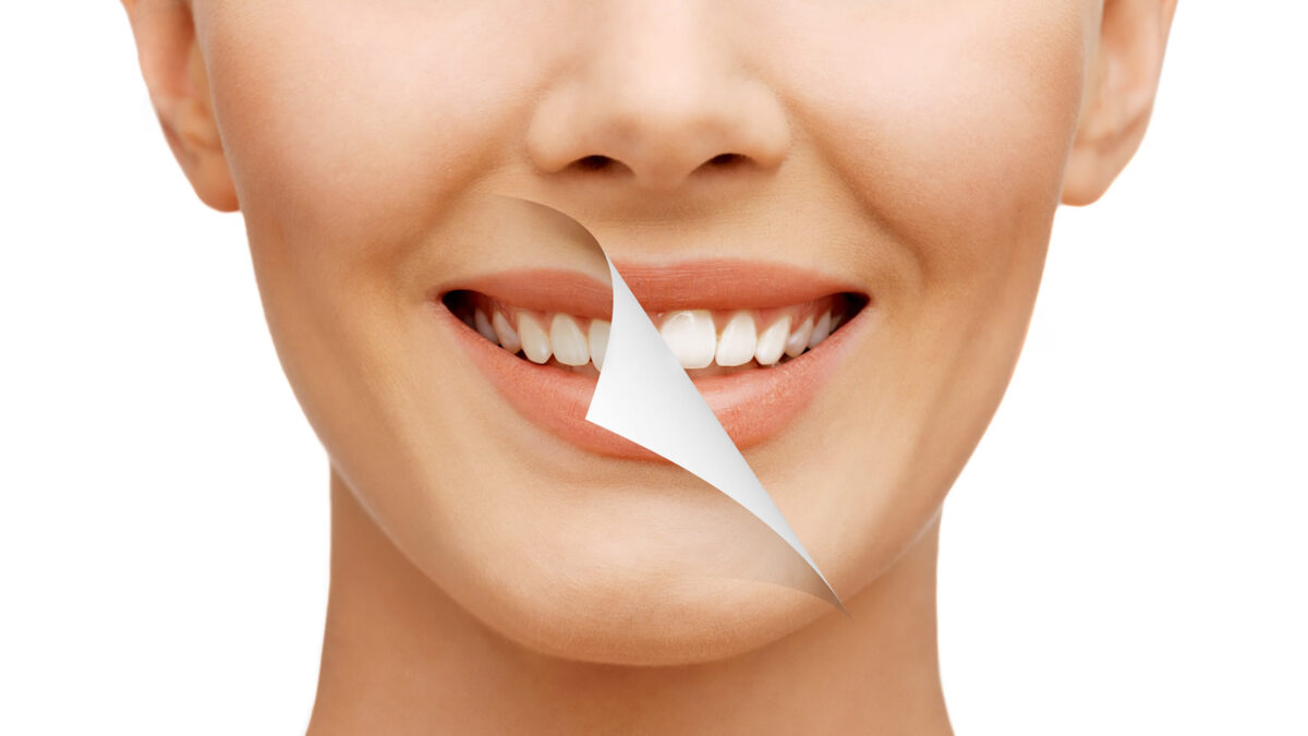 Teeth Whitening Newport Beach Zoom Teeth Whitening