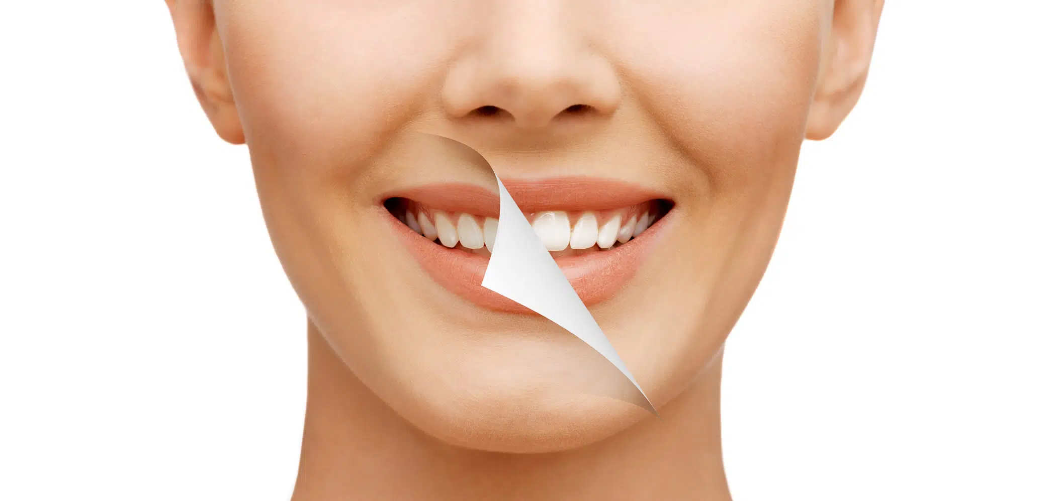 Teeth Whitening Newport Beach Zoom Teeth Whitening