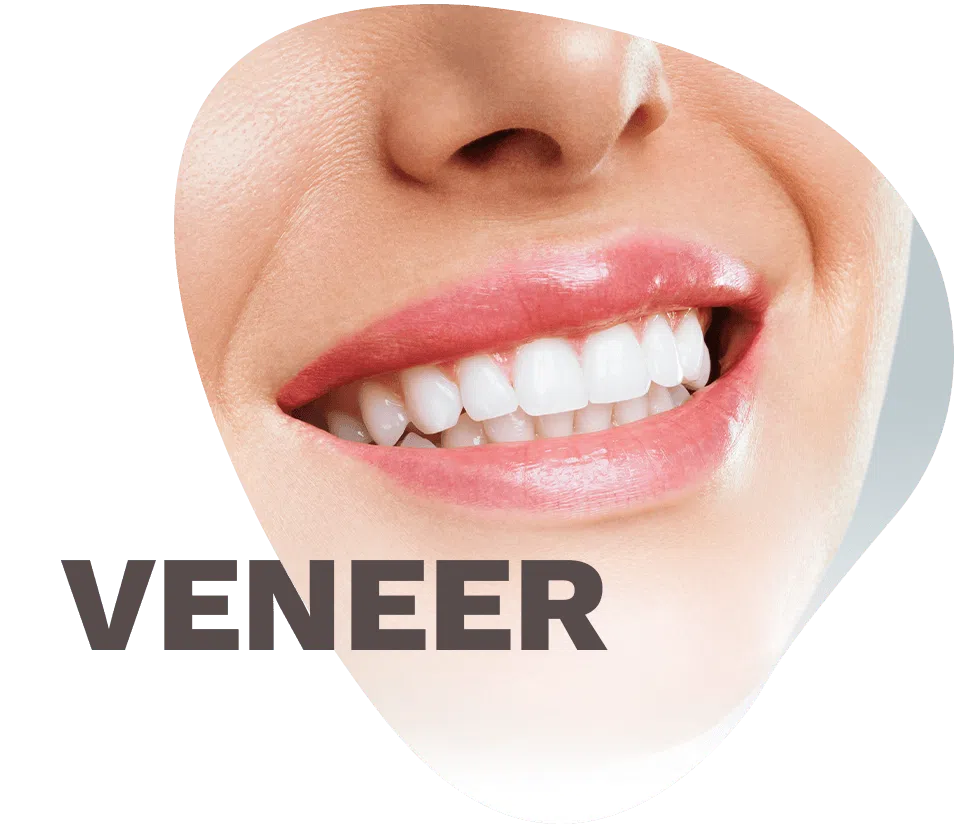 Porcelain Veneers