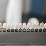 Benefits-of-Veneers-1