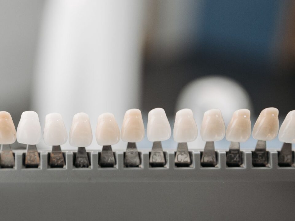 Benefits-of-Veneers-1