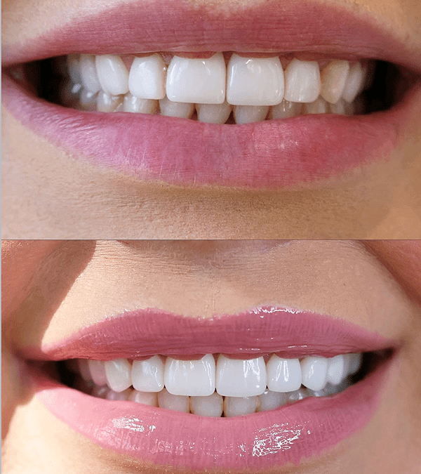 Natural-looking veneers result in Newport Beach