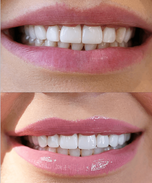 Natural-looking veneers result in Newport Beach