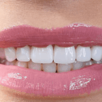 Natural-looking veneers result in Newport Beach