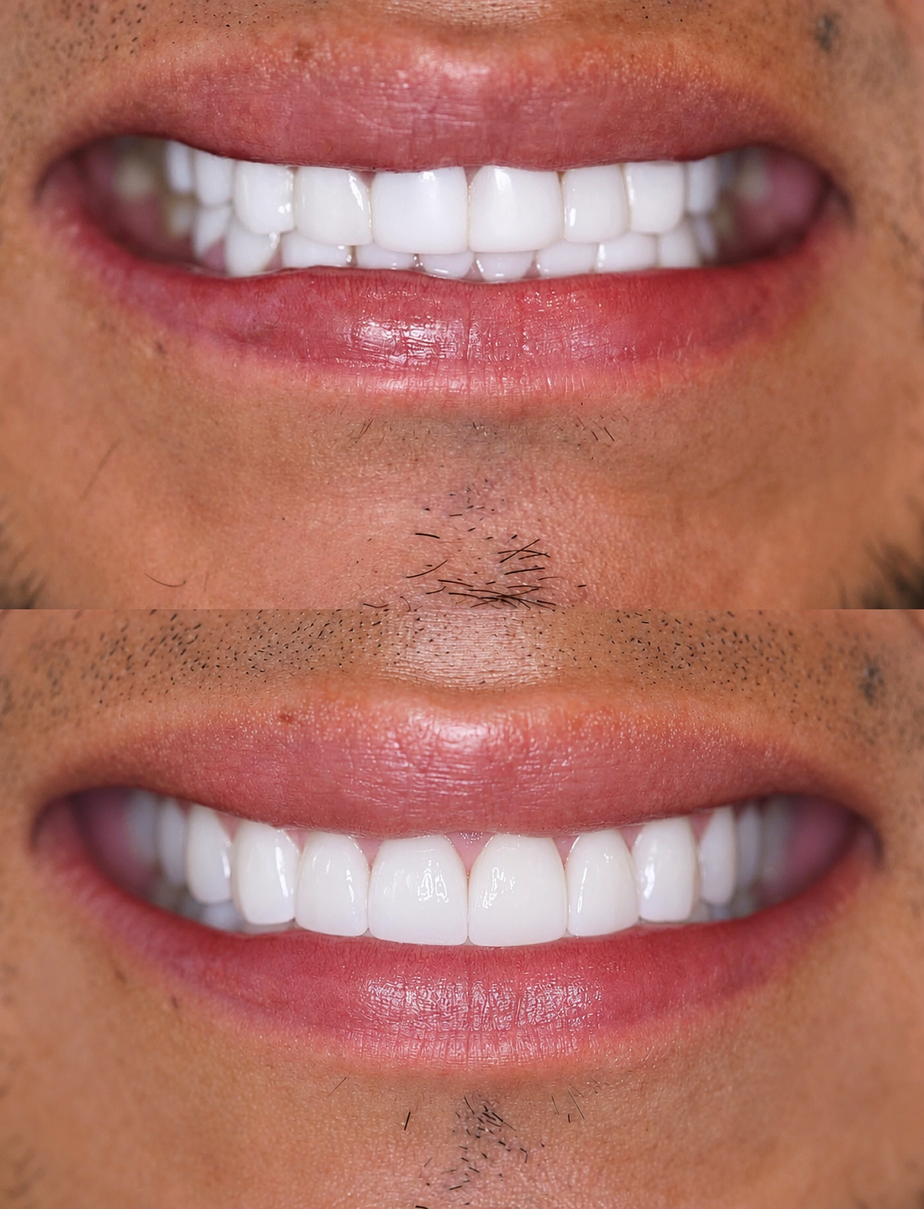 Veneers Dentist Newport Beach 45.fw
