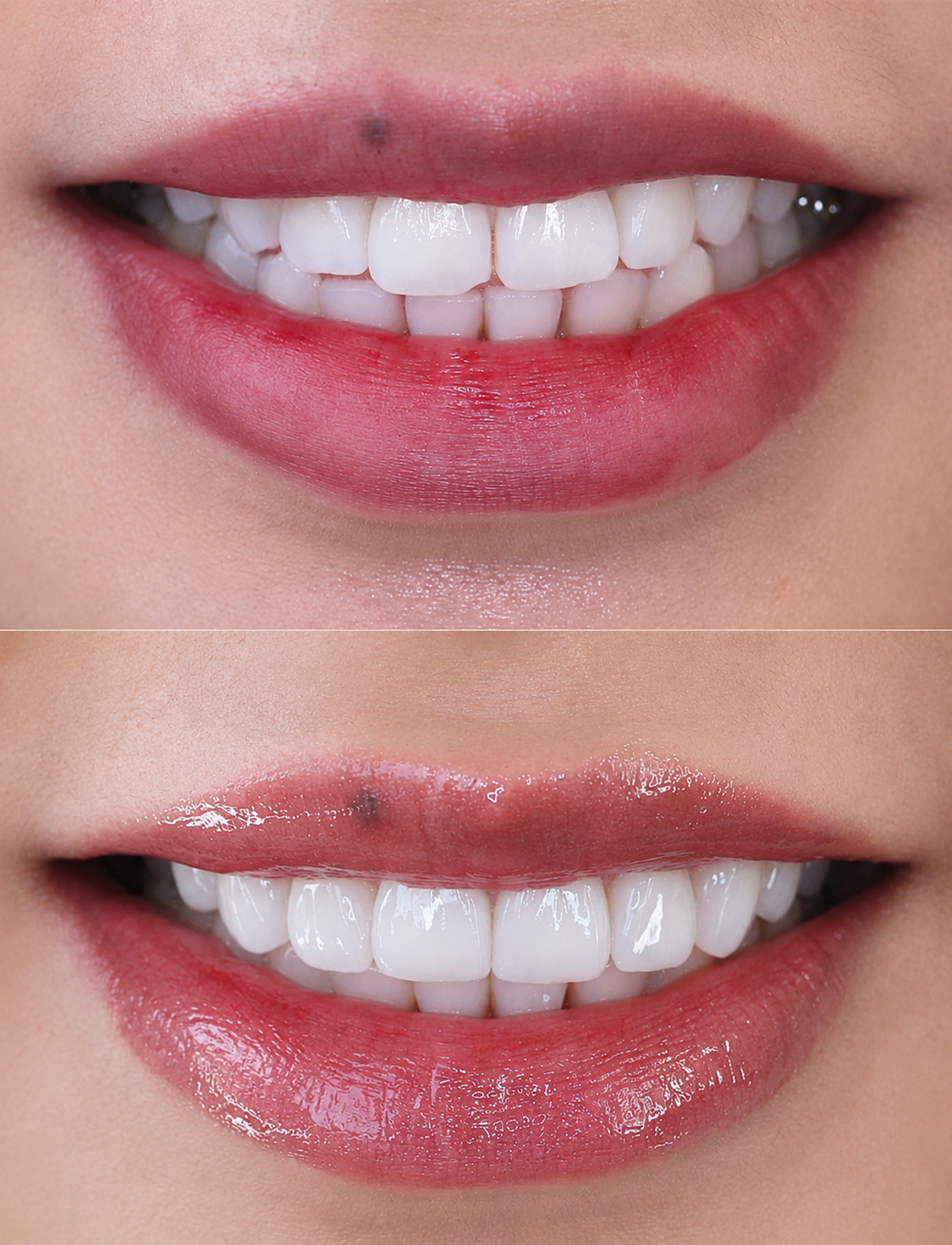 Veneers Dentist Newport Beach 54.fw