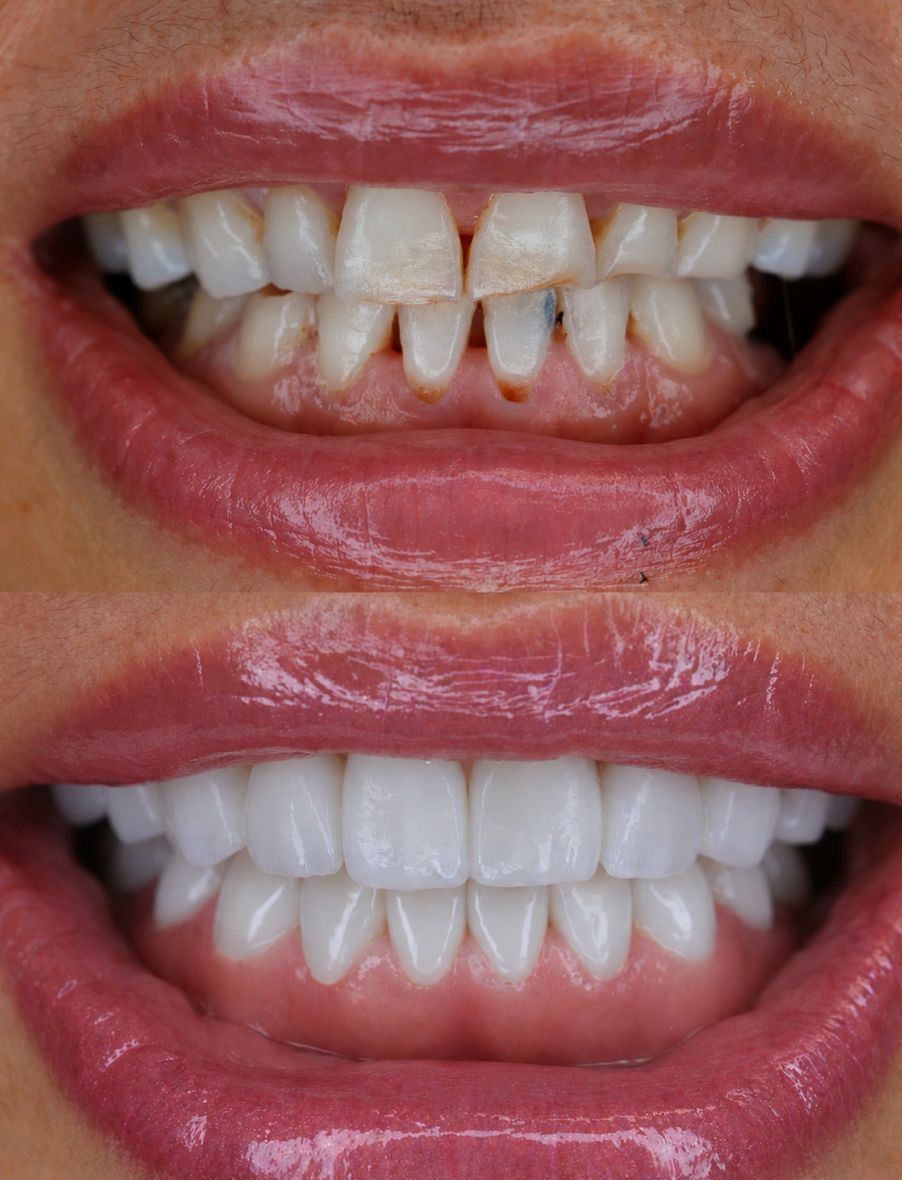 Veneers Dentist Newport Beach 60.fw