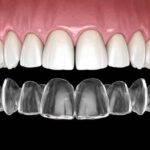 average cost of invisalign — featured image