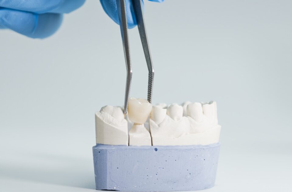 crowns for teeth — featured image