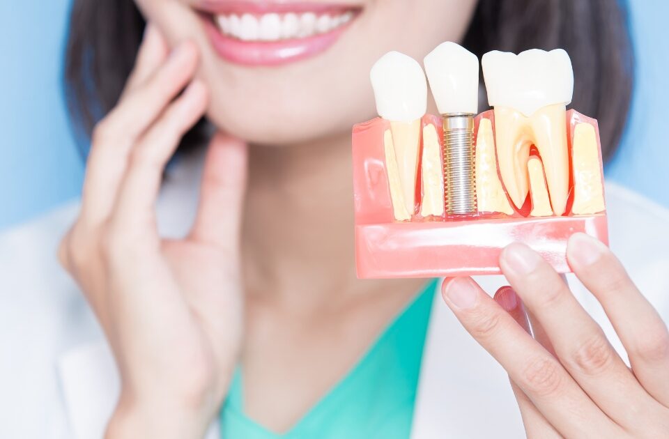 permanent dental implants — featured image