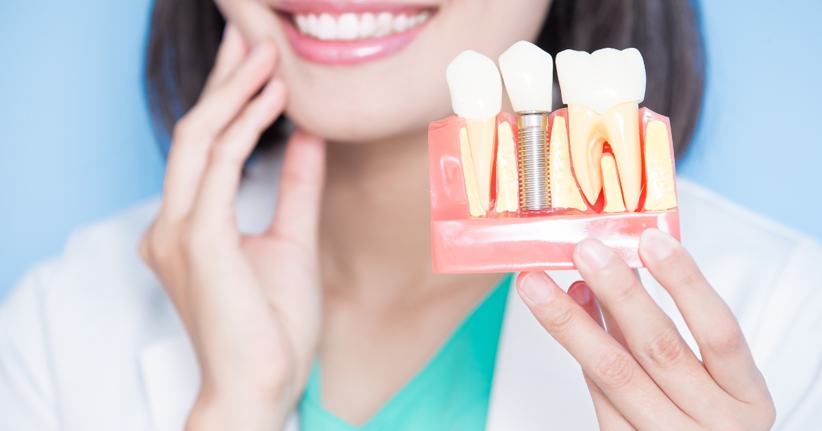 permanent dental implants — featured image
