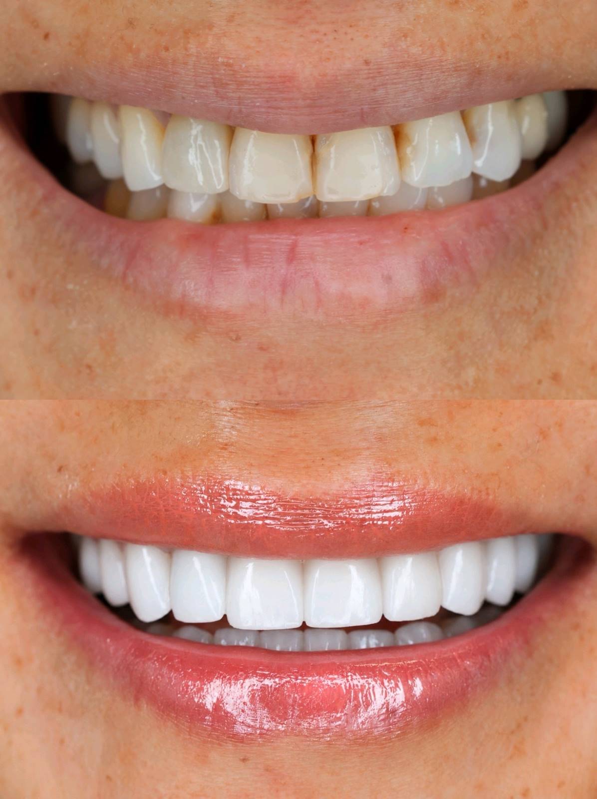 newimgteeth