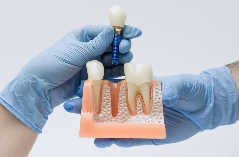 affordable dental implants — featured image