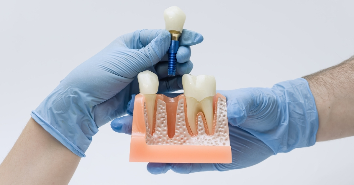 affordable dental implants — featured image